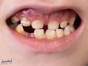 بهداشت نامناسب دهان