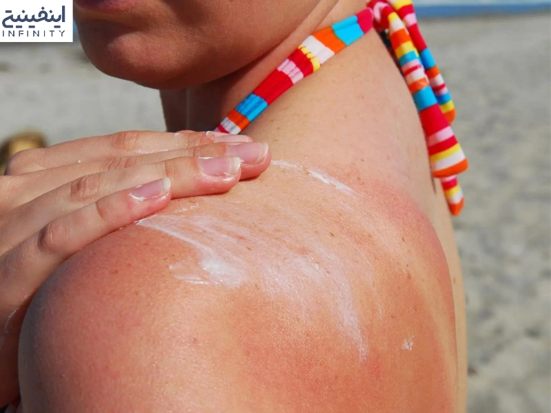 درمان آفتاب سوختگی با مرطوب کننده